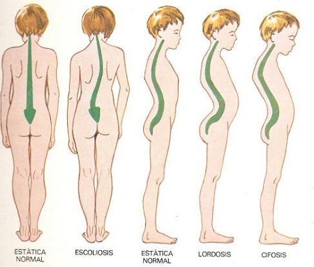 desaroollo columna vertebral niño correcto y desviado desaroollo columna vertebral niño correcto y desviado